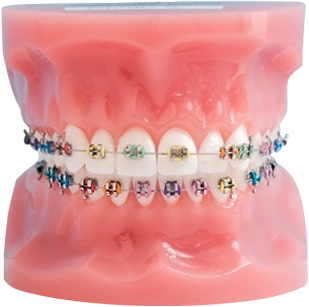 aparat dentar metalic in clinicile dentare dentesse kids and teens