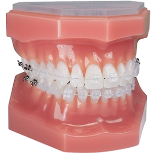 aparat dentar metalic in clinicile dentesse kids and teens