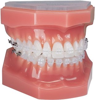 aparat dentar safir sau ceramic