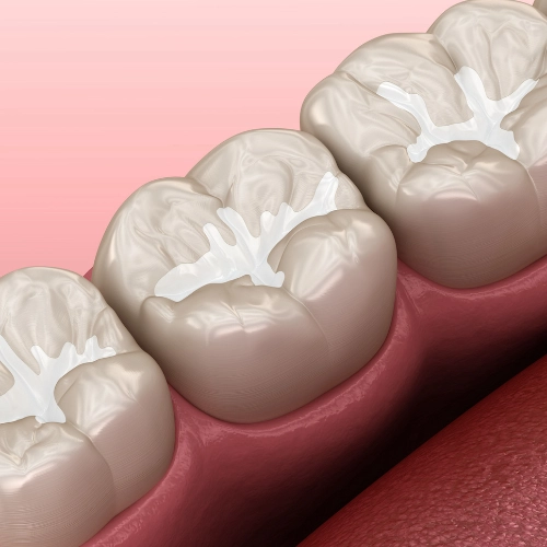 beneficiile sigilarii dentare