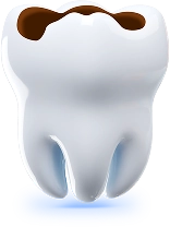 incrustatiile_inlay_onlay_mbl incrustatiile inlay onlay